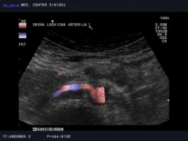 Ultrazvok žil trebuha - normalna desna ledvična arterija